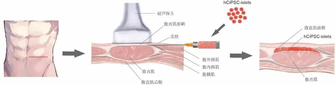 胰島細胞腹直肌前鞘下移植的示意圖